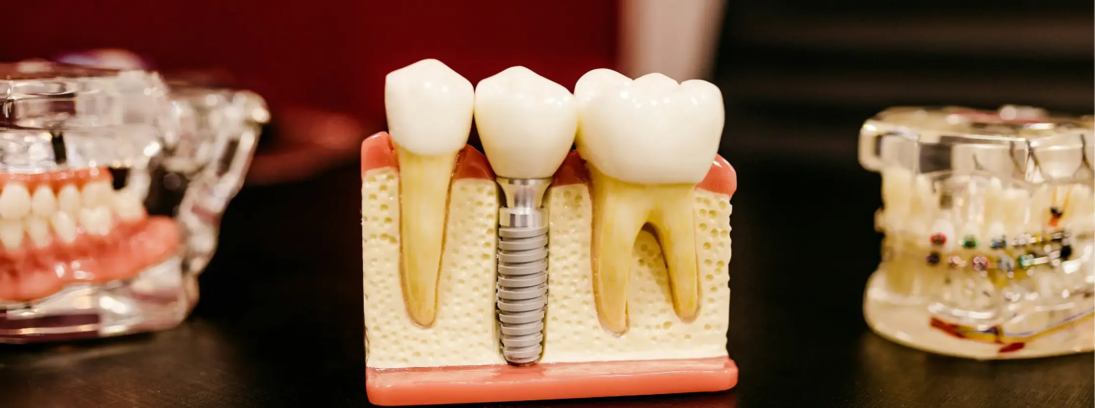 Prosthodontics (Dental Prosthetics)